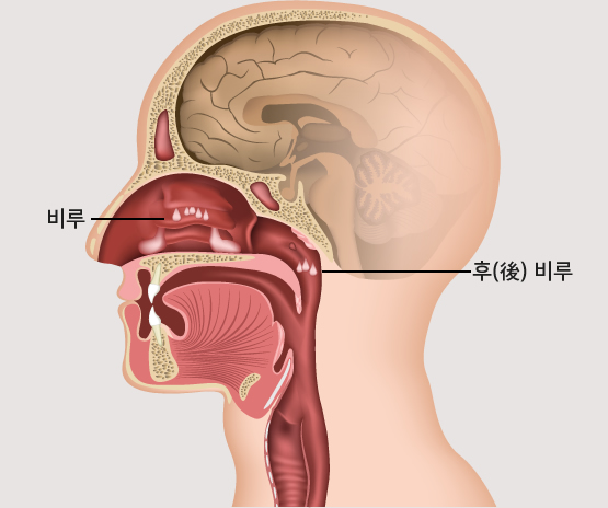 비염