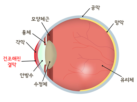 안구건조증 설명 예시이미지