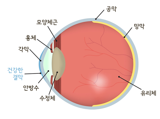 안구건조증 설명 예시이미지
