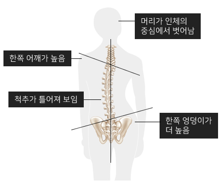 척추측만증이란?