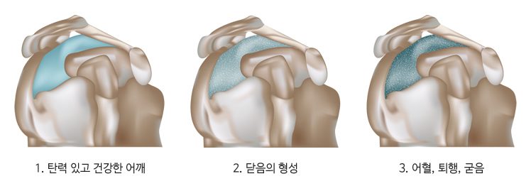 오십견의 진행단계 예시이미지