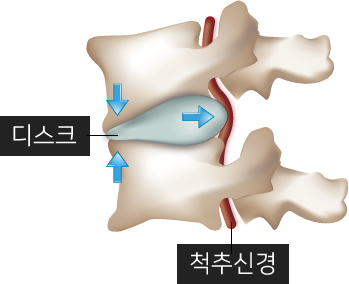 허리디스크의 진행단계 예시이미지